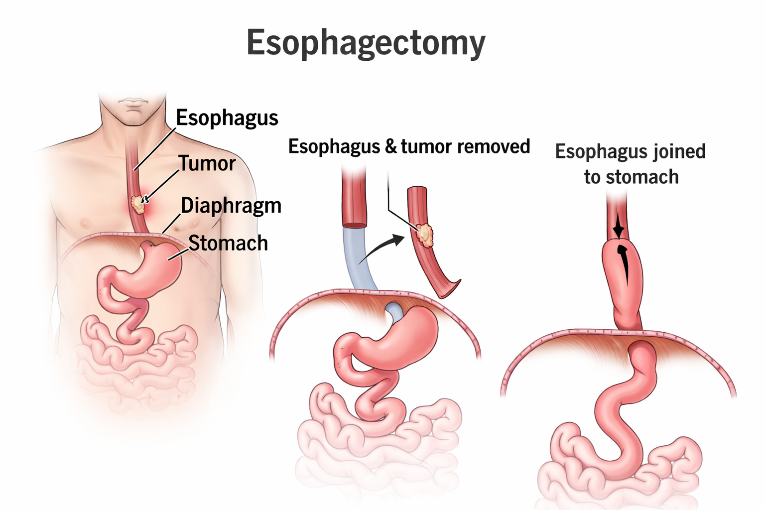 Diagram showing esophagus before and after esophagectomy with reconstruction